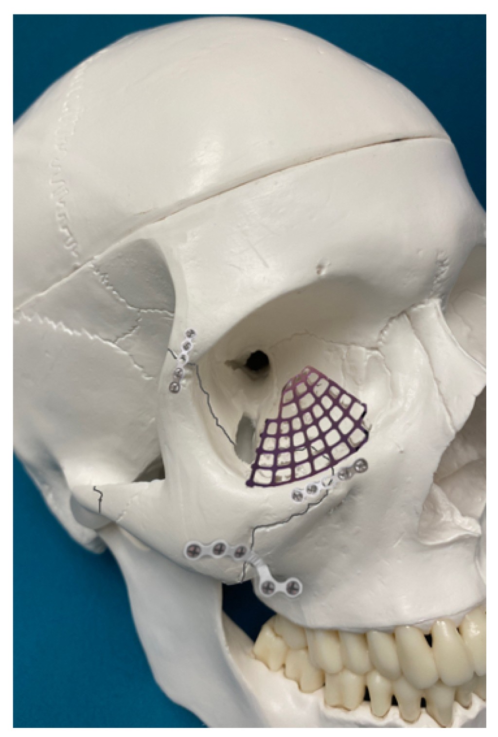 Sumber Perubatan Zygomatic: Panduan Anatomik & Rawatan Maksimum